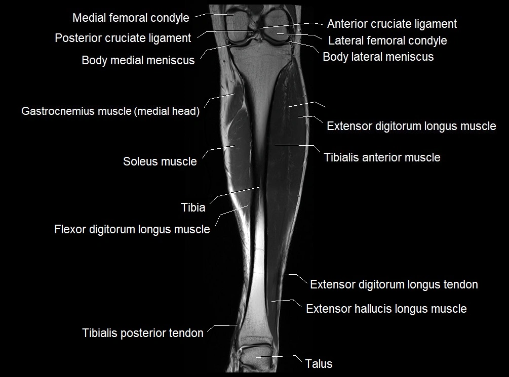 MRI 3T leg (tibia & fibula) labelled coronal cross sectional anatomy image 14.webp